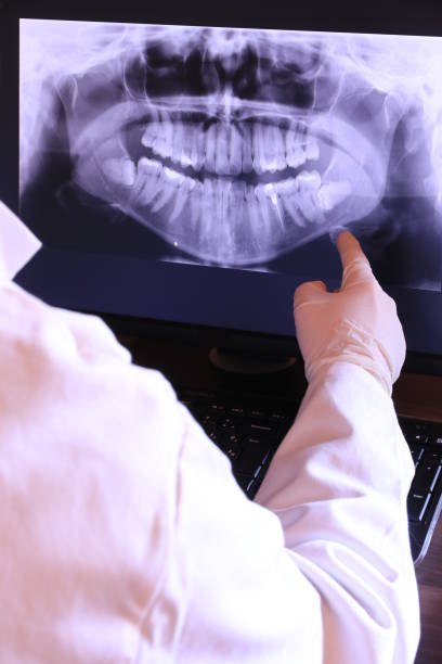 Best Emergency Wisdom Teeth Removal in Fircrest, WA